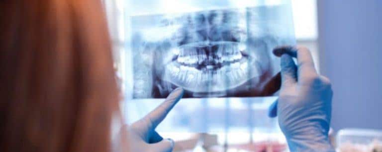 Röntgen von schiefen Zähnen