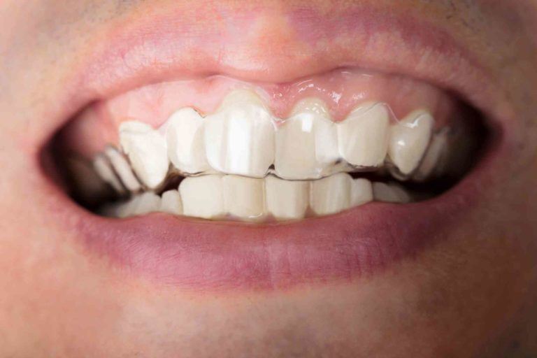 Schiefe Zähne mit durchsichtiger Zahnspange