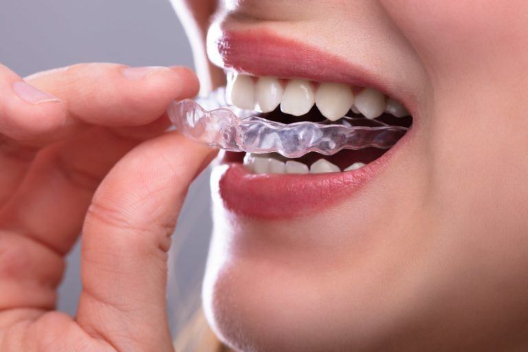 Invisalign Aligner Zahnspange