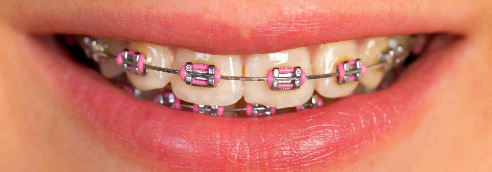 Brackets Die Festsitzende Zahnspange Fur Kinder Erwachsene